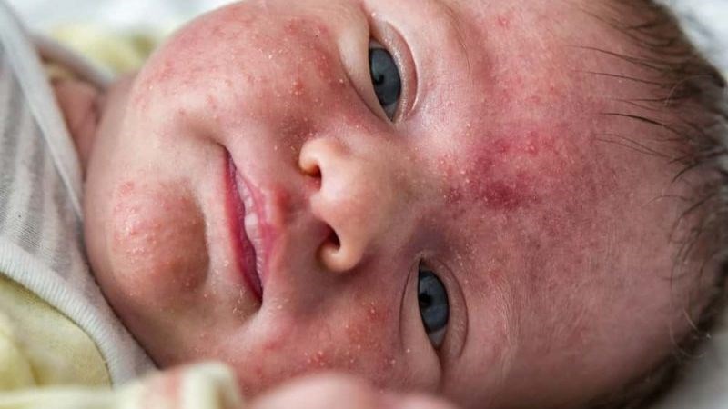 Viêm da do liên cầu khuẩn thường gặp ở trẻ nhỏ