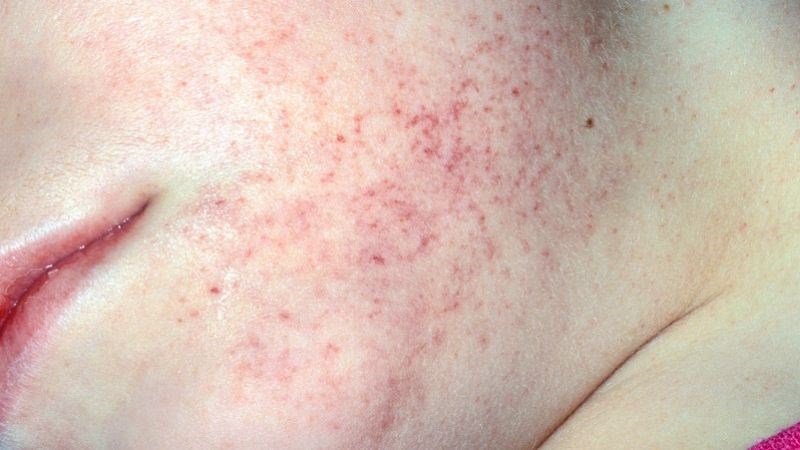 Một số bệnh tự miễn gây xuất hiện ban đỏ trên da