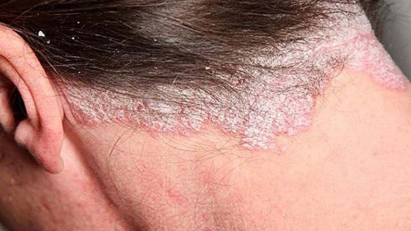 Tổn thương đặc trưng của bệnh vảy nến là lớp vảy trắng trên nền da đỏ