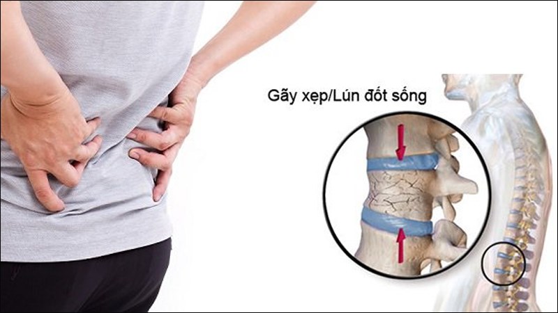 Loãng xương làm xẹp/lún cột sống