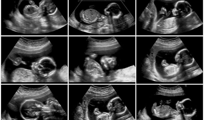 Dấu hiệu nhận biết thai nhi 20 tuần phát triển khoẻ mạnh