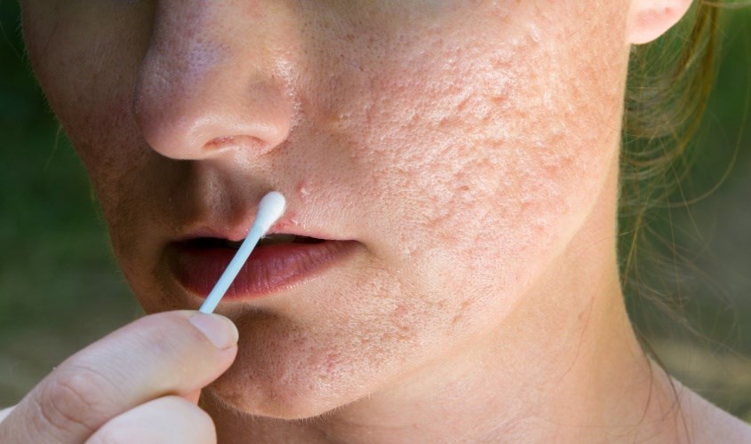 Tia UV cao khiến da dễ nổi mụn, sần sùi