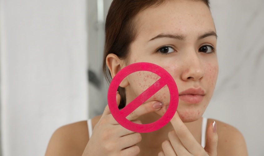 Hạn chế dùng tay nặn mụn