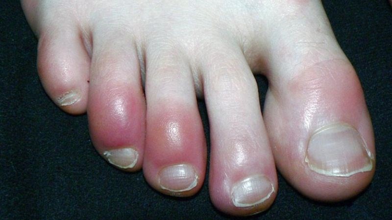 Sưng, nóng, đỏ, đau là dấu hiệu của sưng ngón chân