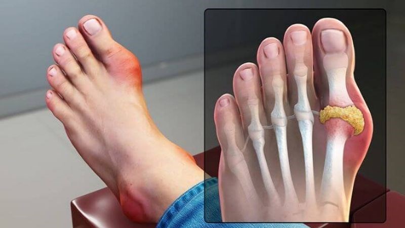 Viêm khớp gây ra các tình trạng như sưng tấy, khó chịu và cứng khớp