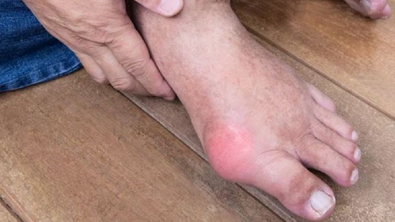 Bệnh gout gây ra các tình trạng đau nhức đột ngột và sưng tấy