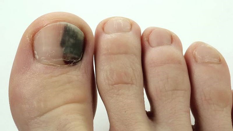 Nhiễm trùng da, mô mềm tại ngón chân gây phù, sưng và có kèm theo sốt