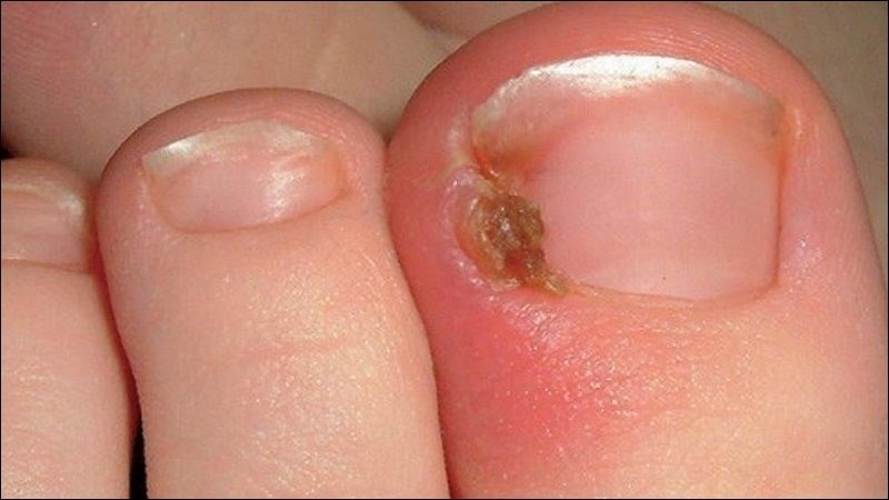 Móng chân mọc ngược gây sưng tấy, đau, đỏ và có thể bị nhiễm trùng.