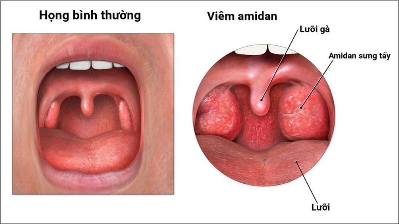 Amidan của bệnh nhân viêm amidan sưng to hơn so với bình thường