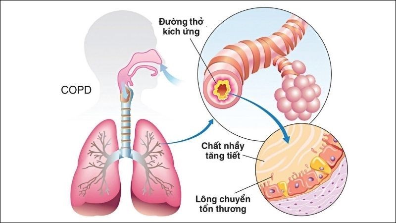 Các chất ô nhiễm kích thích niêm mạc đường thở gây nên tình trạng viêm nhiễm