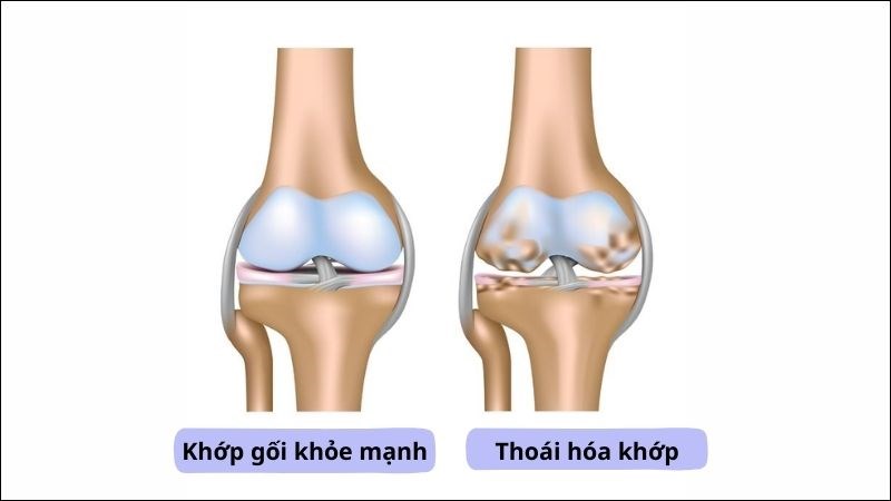 Thoái hóa khớp (Osteoarthritis) là một dạng viêm khớp phổ biến Thoái hóa khớp (Osteoarthritis) là một dạng viêm khớp phổ biến