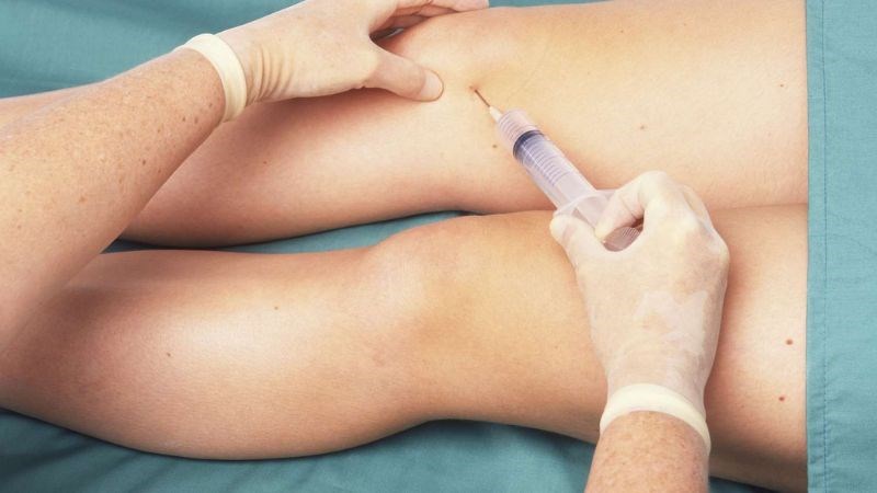 Chọc hút dịch khớp để xác định nguyên nhân gây đau khớp Chọc hút dịch khớp để xác định nguyên nhân gây đau khớp