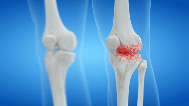 Thoái hóa khớp xảy ra khi sụn đệm trong khớp dần bị thoái hóa Thoái hóa khớp xảy ra khi sụn đệm trong khớp dần bị thoái hóa