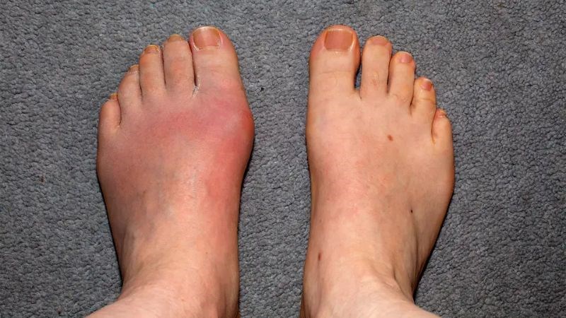 Bệnh gout có thể gây thoái hóa khớp thứ phát Bệnh gout có thể gây thoái hóa khớp thứ phát