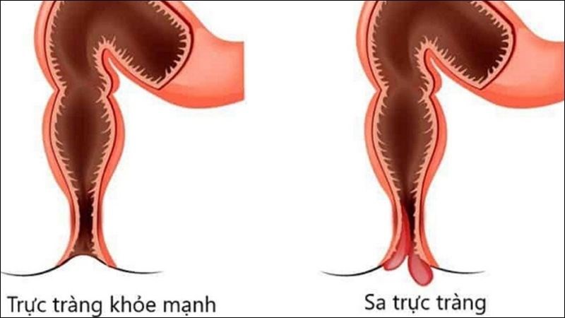 Một phần trực tràng bị lòi ra khỏi hậu môn trong bệnh sa trực tràng