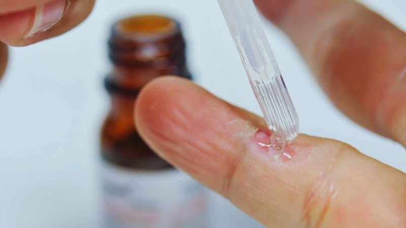 Có thể chấm dung dịch axit salicylic và axit lactic lên vùng da chứa mụn cóc