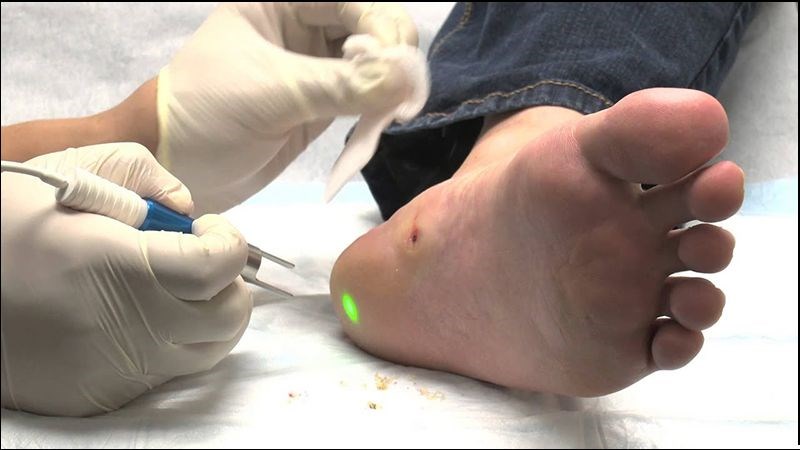 Dùng laser là một trong những phương pháp trị mụn cóc