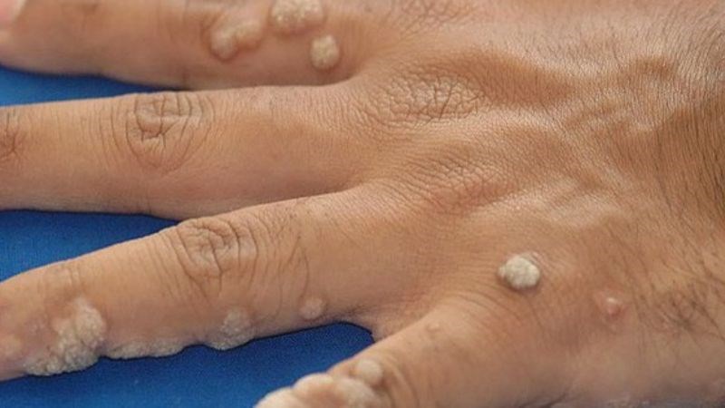 Khi mụn cóc lây lan sang các vùng khác nên đến gặp bác sĩ để được điều trị kịp thời