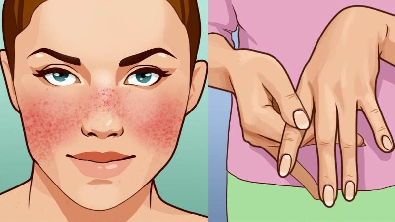 Bệnh lupus ban đỏ thường gây tổn thương ban da đặc trưng và tổn thương các khớp