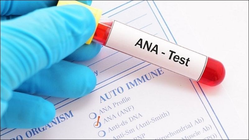 Xét nghiệm tìm kháng thể ANA trong chẩn đoán lupus ban đỏ