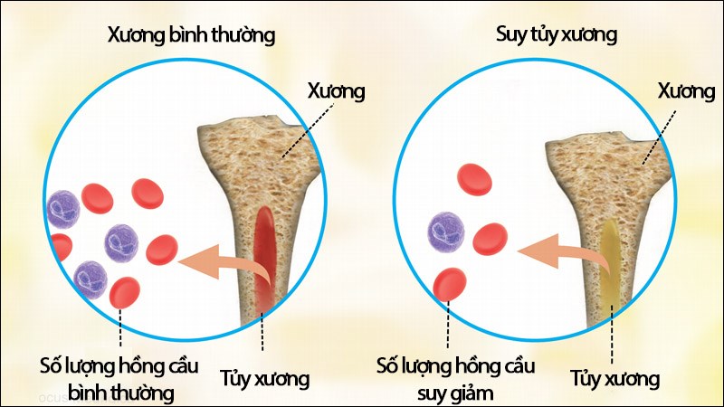 Tự kháng thể có thể tấn công vào dòng tế bào máu gây suy tủy xương
