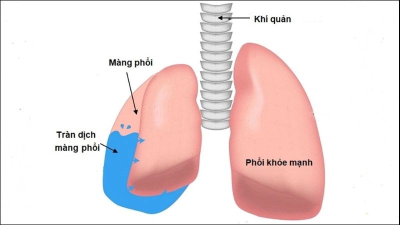 Tràn dịch màng phổi là tình trạng lượng dịch màng phổi nhiều bất thường