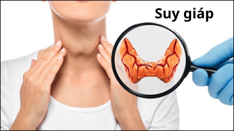 Suy giáp gây tăng giữ nước toàn cơ thể