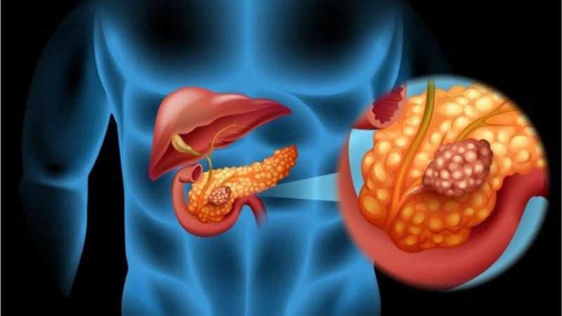 Viêm tụy gây viêm cơ hoành rồi dẫn tới viêm màng phổi