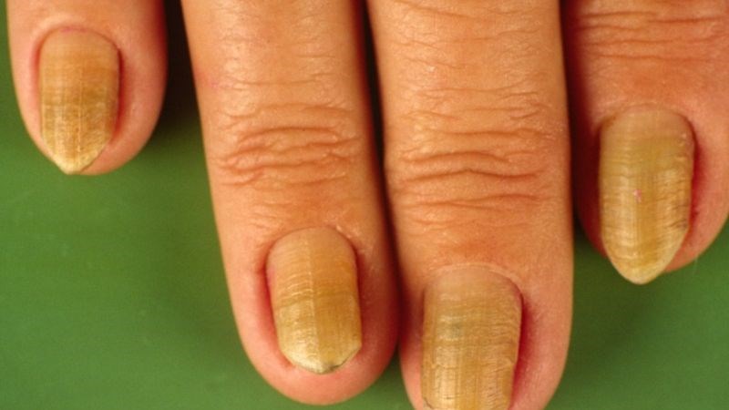 Tràn dịch màng phổi là một trong ba tam chứng kinh điển của hội chứng móng tay vàng