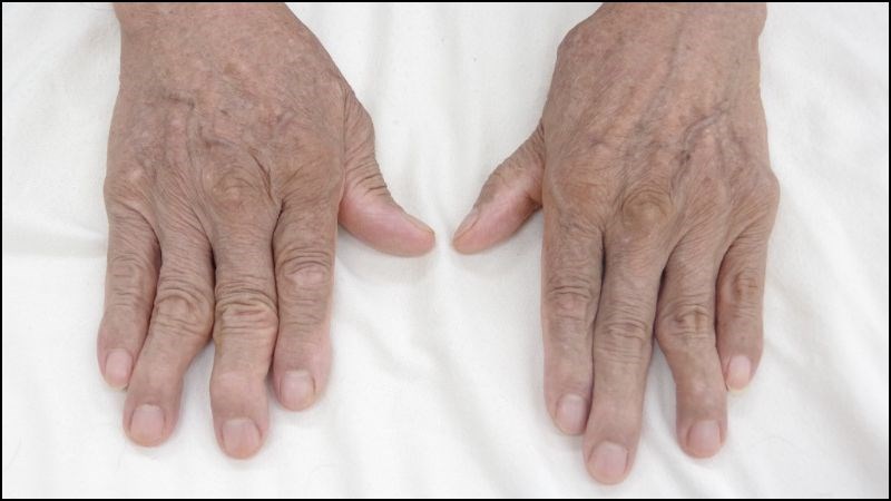 Viêm khớp dạng thấp gây tăng nguy cơ viêm nhiễm và tổn thương phổi