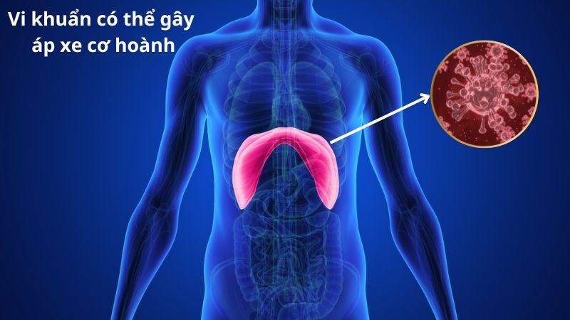 Áp xe cơ hoảnh có thể gây tình trạng viêm màng phổi