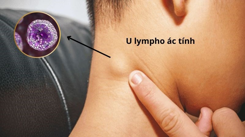 U lympho ác tính có thể xâm nhập và gây viêm màng phổi