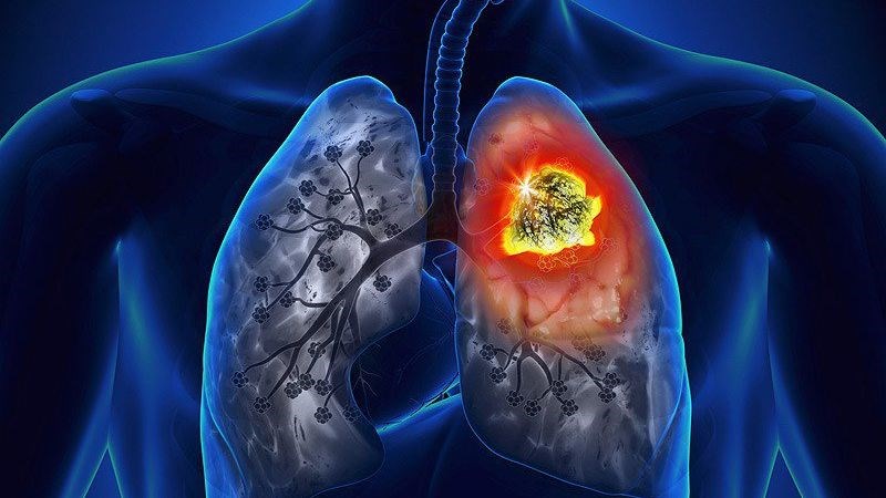 Ung thư phổi lan đến màng phổi làm tế bào ung thư nhanh chóng phân chia gây ảnh hưởng màng phổi