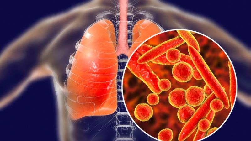 Lao màng phổi làm tế bào màng phổi không ngừng tiết dịch