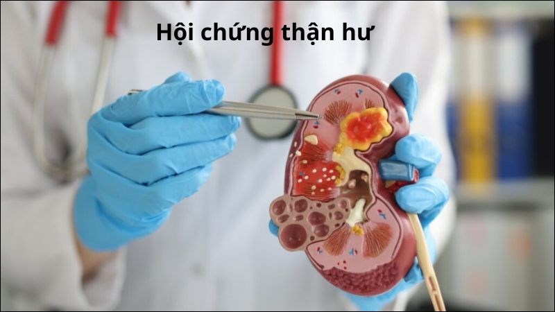 Hội chứng thận hư gây tràn dịch đa màng trong đó có màng phổi
