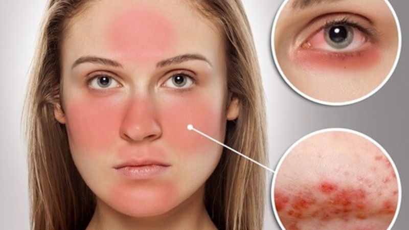 Lupus ban đỏ hệ thống sẽ tấn công vào hệ miễn dịch tất cả các cơ quan trong đó có phổi
