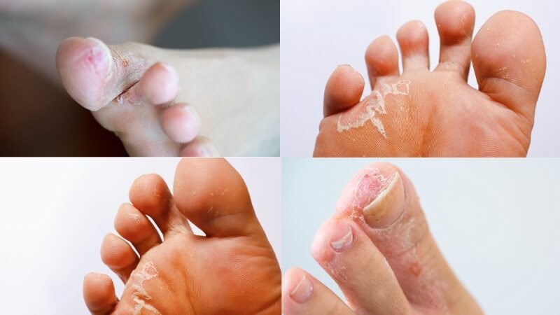 Dấu hiệu điển hình của bệnh nước ăn chân là giữa các ngón và lòng bàn chân xuất hiện các mảng trắng, bong vảy hoặc nứt da
