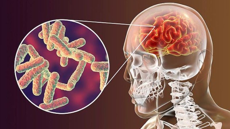 Viêm màng não là một trong những biến chứng của ngộ độc thực phẩm