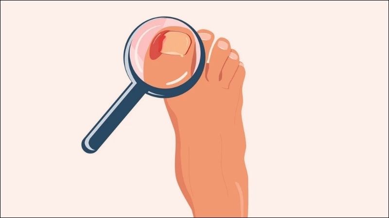 Vết thương ở móng sẽ tạo điều kiện cho nấm xâm nhập gây bệnh