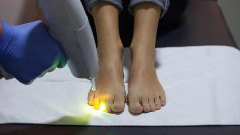 Ánh sáng laser giúp hỗ trợ tiêu diệt mầm bệnh nấm móng