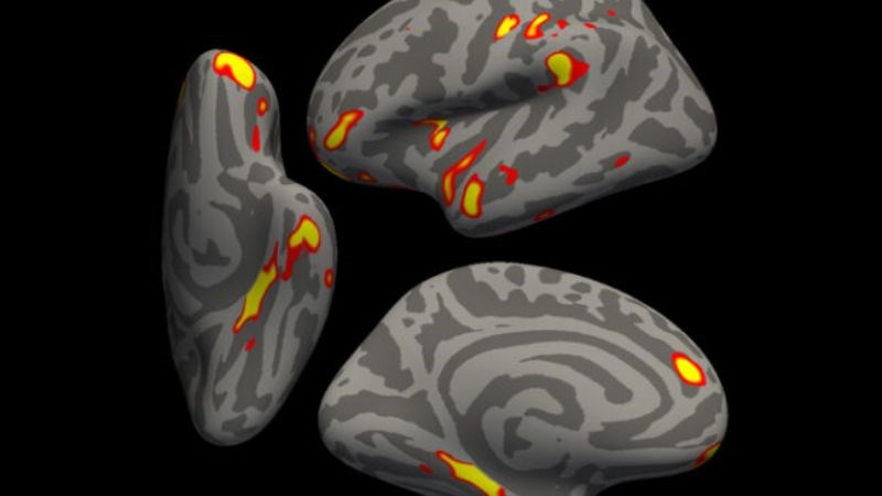 V&ugrave;ng n&atilde;o xử l&yacute; th&ocirc;ng tin khứu gi&aacute;c (m&agrave;u đỏ v&agrave;ng) c&oacute; thể thay đổi k&iacute;ch thước sau Covid-19