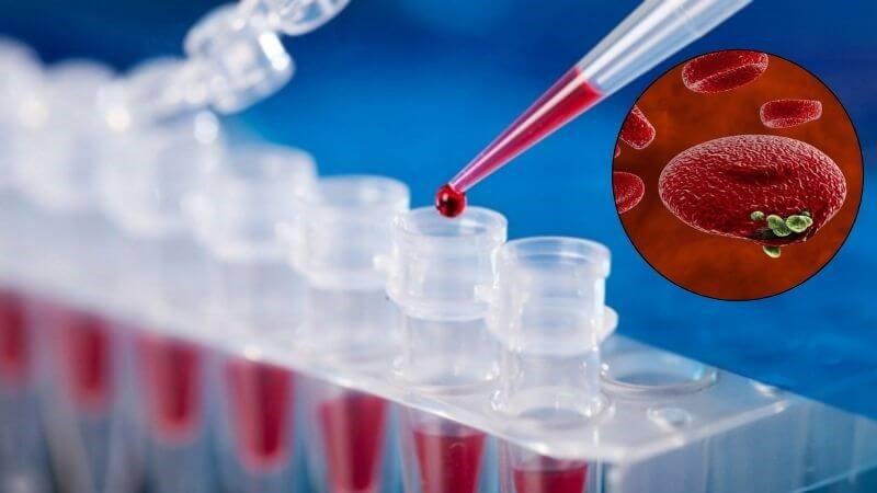 Xét nghiệm định lượng sắt có thể chẩn đoán bất thường hồng cầu và hemoglobin
