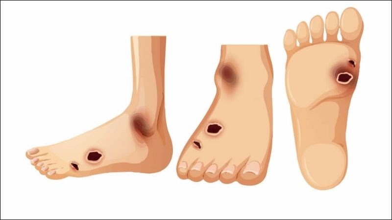 Phát hiện sớm bàn chân khi bị đái tháo đường để điều trị kịp thời