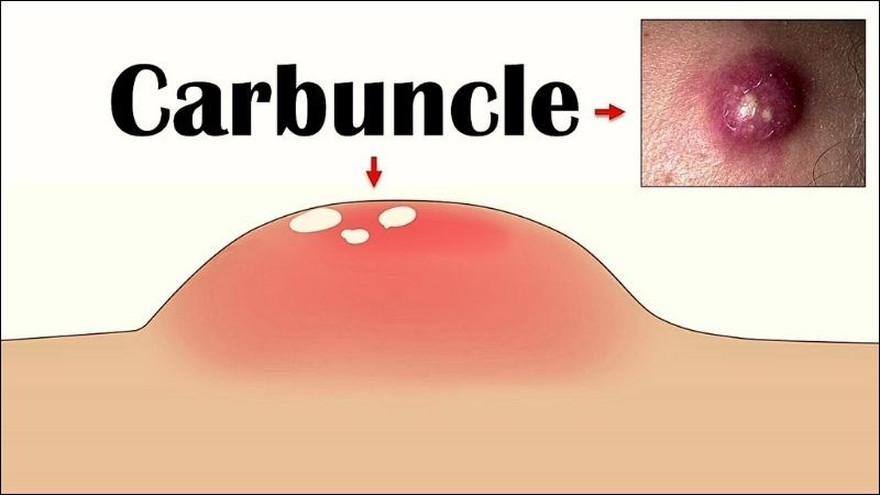 Hậu bội có thể gây ra hoại tử tế bào 