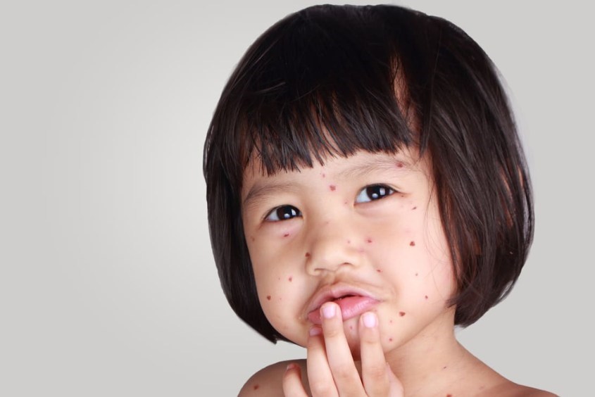 Kiêng khem quá mức khi trẻ bị thủy đậu có thể làm trẻ bị thiếu chất, giảm sức đề kháng