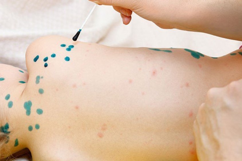 Không tự ý bôi thuốc cho trẻ khi chưa có chỉ định từ bác sĩ