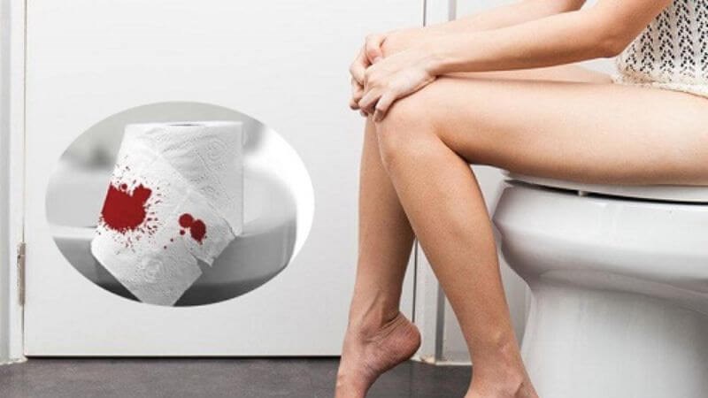 Nứt kẽ hậu môn gây nên chảy máu khi đi đại tiện