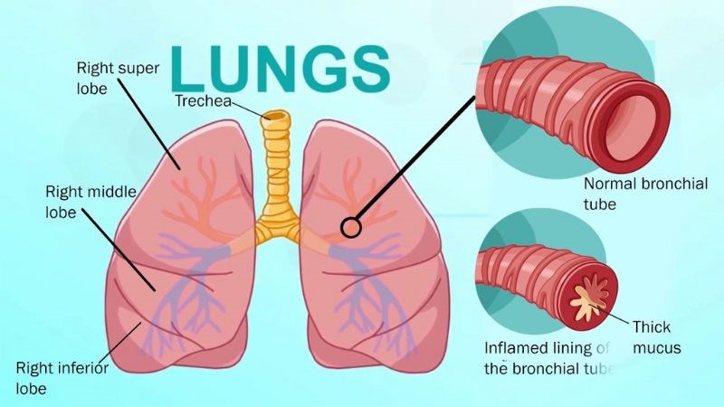 Viêm phế quản dễ xảy ra sau bệnh covid-19 nên gây ho dai dẳng