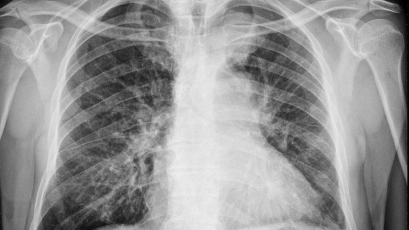 Hình ảnh XQuang phổi giúp gợi ý chẩn đoán các bệnh nghiêm trọng ở phổi