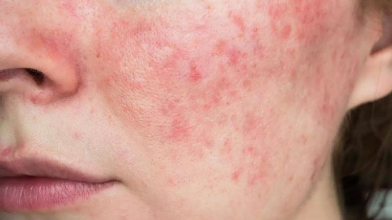Da bị phát ban trong bệnh lupus ban đỏ